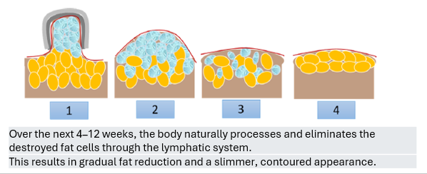 Cristal Pro® | CoolSculpting® | Fat Freezing JB | Aesthetic Clinic JB